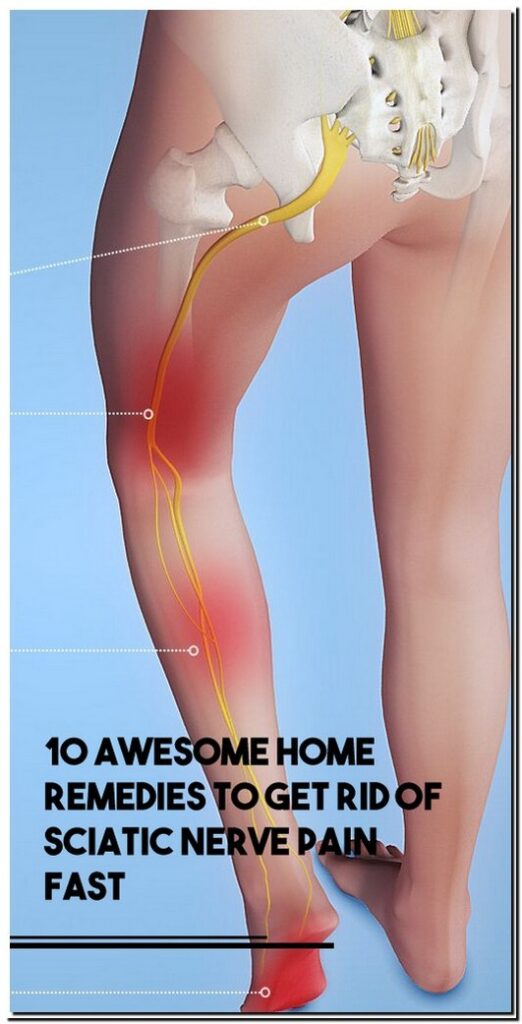 10-awesome-home-remedies-to-get-rid-of-sciatic-nerve-pain-fast-all